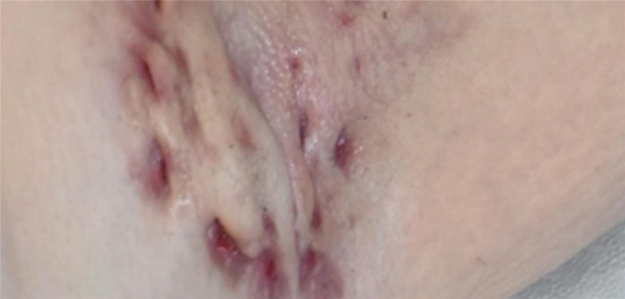 Die stille Last der Acne inversa