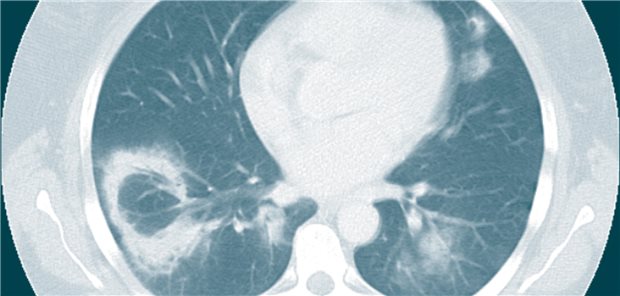 Eosinophile Infiltrate bei einer 54-jährigen Patientin infolge einer ACE-Hemmer Therapie. Schnelle Rückläufigkeit nach Karenz.