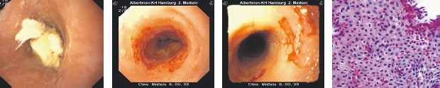 Eosinophile Ösophagitis: Bolus in der Cardia feststeckend (li.), Ösophagusschleimhaut mit Gewebseosinophilie (re).