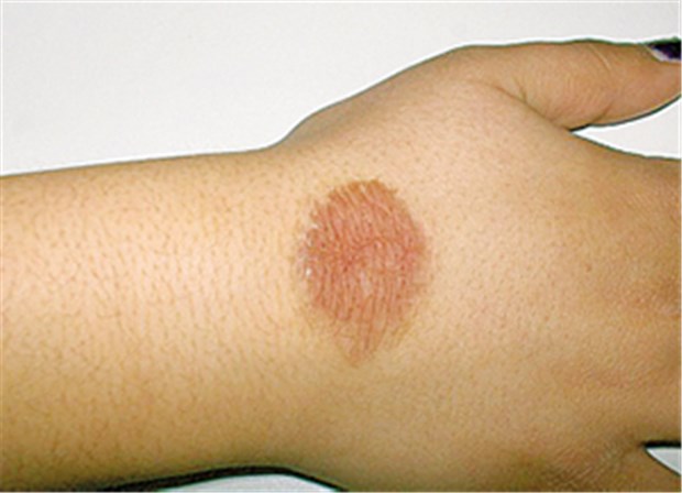 Deospray verursacht Erfrierung 1. Grades Erfrierungen ersten Grades am rechten Handrücken nach Anwendung eines Sprühdeodorants aus wenigen Zentimetern Entfernung.