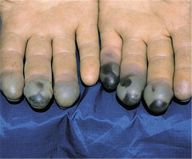 Schnelle Hilfe bei lokalen Erfrierungen Erfrorene Fingerspitzen Grad 2 mit zum Teil blutgefüllten Blasen. Bei dem Bergsteiger wurde später die Spitze des linken Ringfingers amputiert. © Walter Treibel