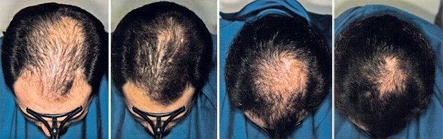 Ergebnis der Behandlung eines Patienten mit Alopezie im Frontal- und Vertexbereich mit 1 mg Finasterid vor der Therapie und nach sechs Monaten.