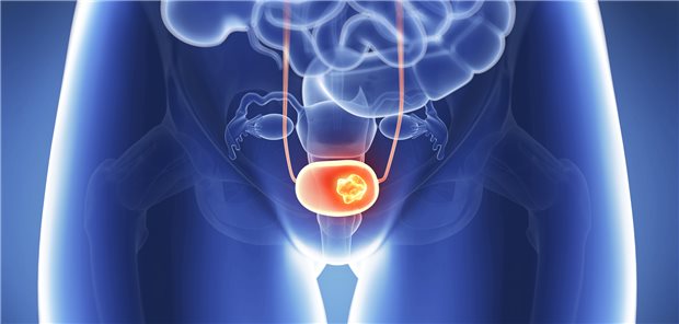 Erhielten Erkrankte mit metastasierten Urothelkarzinomen nach einer Progression unter Pembrolizumab eine erneute und meist platinbasierte Chemotherapie, lebten sie rund acht Monate länger als bei einer fortgesetzten Behandlung mit dem PD-1-Hemmer.