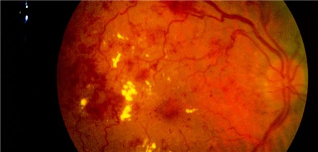 Erkennung einer diabetischen Retinopathie mittels Künstlicher Intelligenz? In Deutschland noch nicht denkbar.