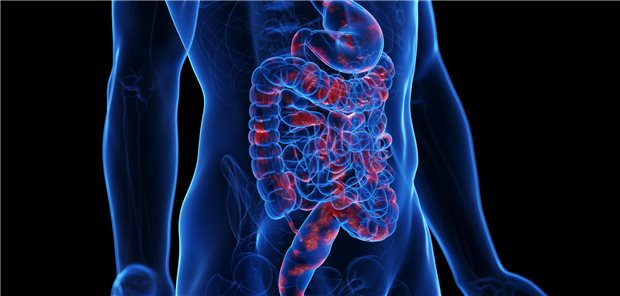 Dreidimensionale gerenderte Darstellung der chronisch-entzündlichen Darmerkrankung Morbus Crohn.