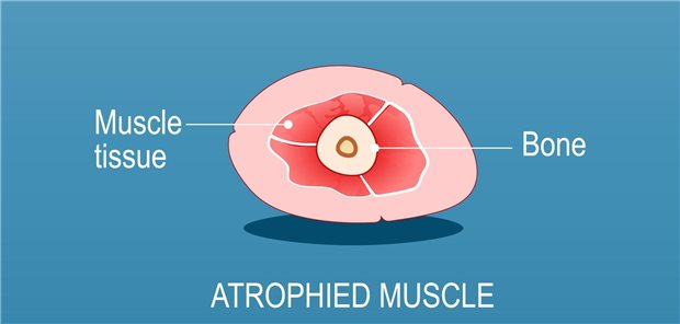 Ernährungswissenschaftlerinnen und -wissenschaftler aus Frankreich und den Niederlanden betonen, dass Sarkopenie und sarkopenische Adipositas in der älteren Bevölkerung durchaus verbreitet sind und dass beide Phänotypen mit einer erhöhten Mortalität assoziiert sind.