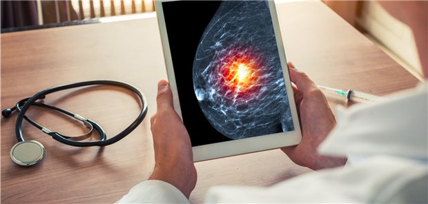 Erneute Diagnose Brustkrebs: Liegt es an Zellproliferations-fördernden, die Apoptose hemmenden Mechanismen?