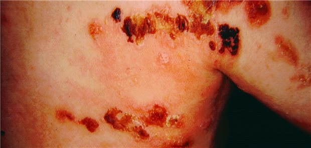 Erscheinungsbild von Epidermolysis bullosa hereditaria: Bei der seltenen Erbkrankheit bilden sich schon bei leichter Berührung der Haut schmerzhafte Blasen.