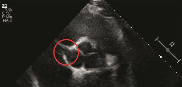 Bild einer transösophagealen Echokardiografie