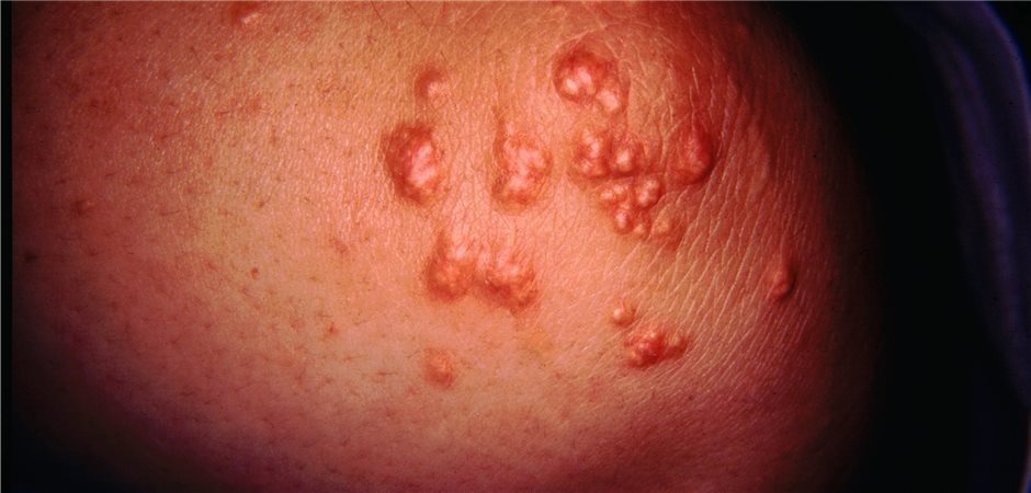 Dieses Hautzeichen einer metabolischen Störung wird oft nicht erkannt