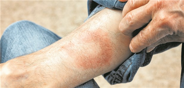 Erythema migrans: Für den Behandlungserfolg spielt es offenbar keine große Rolle, ob die antibiotische Therapie zehn Tage, 14 bis 15 Tage oder drei Wochen dauert.