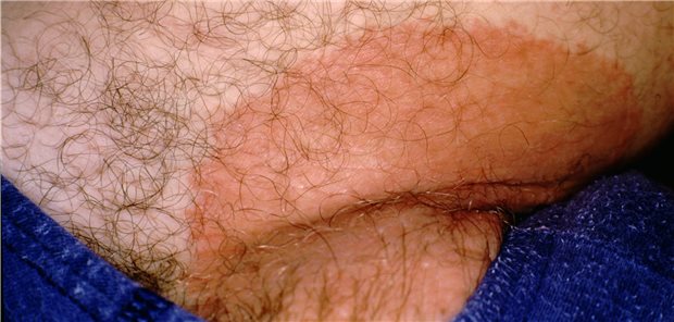 Erythrasma in der Leiste: Hervorgerufen durch Corynebacterium minutissimum manifestiert es sich mit Rötungen in Hautfalten.