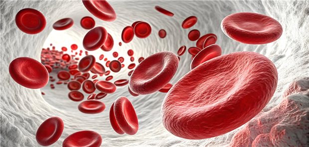 Es gibt Bedenken, dass das erhöhte Erythrozytoserisiko, das unter SGLT2-Inhibitoren beobachtet wird, mit venösen thrombembolischen Ereignissen einhergeht. Das scheint einer israelitschen Kohortenstudie zufolge aber nicht der Fall zu sein.