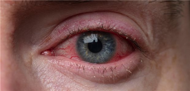 Es gibt zwei Verfahren zu Behandlung einer Blepharitis mit Licht: Die Low-Level Light-Therapie (LLLT) und die Intense Pulsed Light Therapie (IPLT). Bei beiden werden Lichtimpulse auf die Haut in der Nachbarschaft der Lider neben dem Auge platziert, während das Auge selbst zum Schutz abgeschirmt wird.