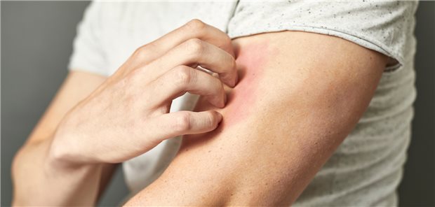 Es juckt! Therapeuten legen Wert auf individuelle Therapiepläne.