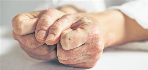 Hände einer PAtientin mit Psoriasis