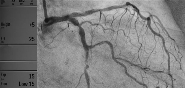 Es müssen keine Stenosen sein - wie hier im RIVA -, die zu Angina-pectoris-Beschwerden führen. Auch Spasmen oder eine mikrovaskuläre Dysfunktion können die Ursache sein.