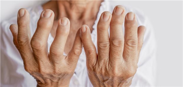 Patientin mit Gichtproblemen an ihren Händen und ihren Fingern.