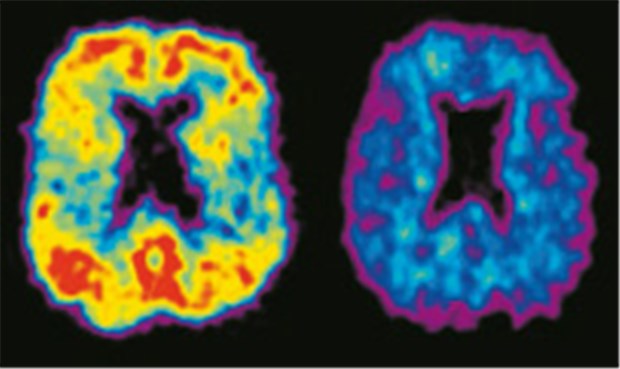 Besseres Bild von Demenzkranken gefordert Es muss nicht gleich ein PET sein (links M. Alzheimer, rechts gesund), ein zerebrales MRT oder CT ist zur Diagnose aber nötig.