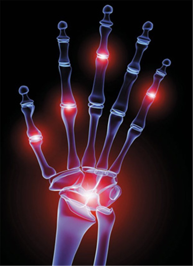 Rheumatoide Arthritis quält Frauen im Alltag stärker als Männer Etwa 0,8 Prozent der Bevölkerung sind an Rheumatoider Arthritis erkrankt. Frauen sind drei Mal so häufig betroffen wie Männer.