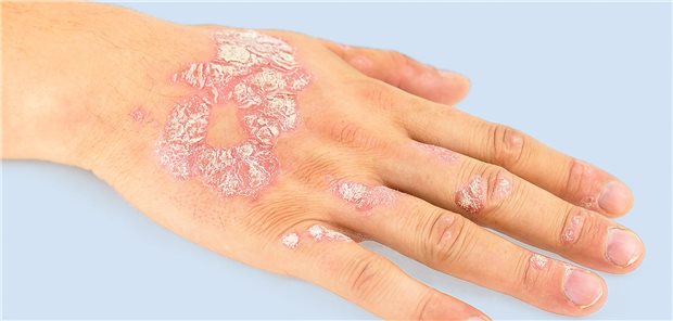 Etwa 10 bis 30 Prozent der Menschen mit Psoriasis erkranken an einer
Psoriasis-Arthritis – entweder parallel, meistens aber Jahre nach den ersten Hautsymptomen.