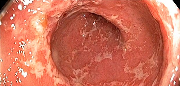 Etwa 150.000 Menschen in Deutschland leiden unter Colitis ulcerosa.