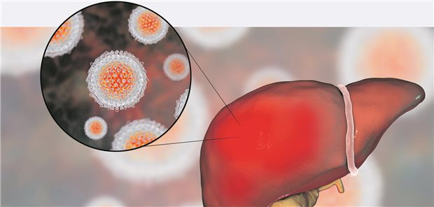 Etwa ein Drittel der Personen mit hepatozellulärem Karzinom war mit Hepatitis C infiziert.
