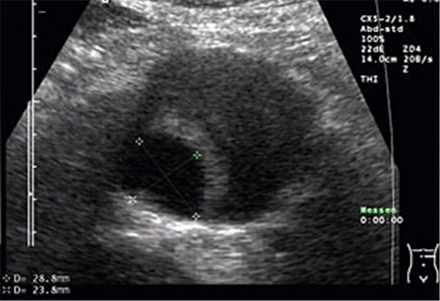 Ultraschall der Aorta: Drei Minuten, die Leben retten Exentrisches Bauchaorten-Aneurysma im Ultraschall: unten links zwischen den Sternchen das Lumen, rechts davon der thrombosierte Anteil.