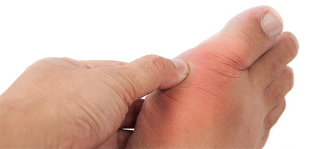 Experten plädieren für eine frühzeitige Therapie bei Gichtanfällen.