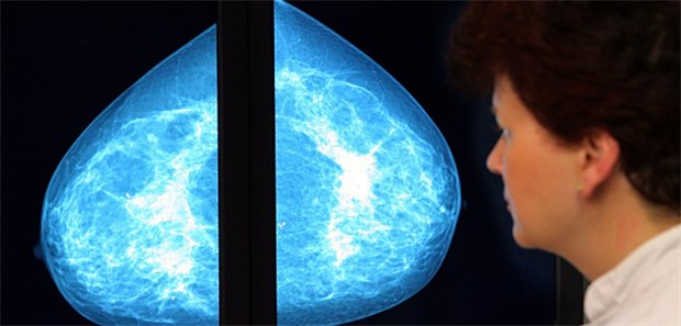 Führt Brustkrebsscreening vor allem zu Überdiagnosen? Experten streiten erneut über den Nutzen des Mammografie-Screenings.