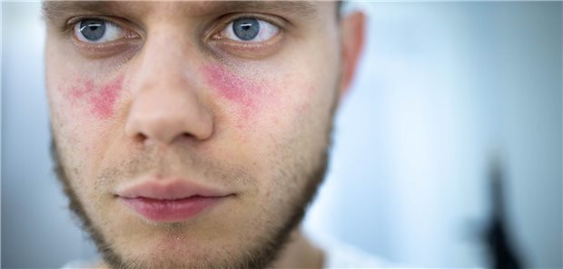 Ein junger Mann, der an systemischem Lupus erythematodes leidet mit dem für die Krankheit typischen schmetterlingsförmigen Hautausschlag im Gesicht.