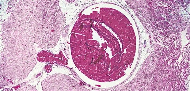 FXI-ASO verhindert die Entstehung von VTE, indem es den Faktor-XI-Spiegel senkt.