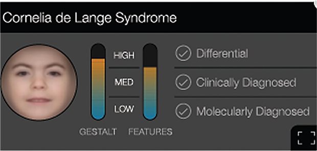 Face2Gene prüft Gesichtsmerkmale auf Anzeichen für Seltene Krankheiten – und gibt die jeweilige Wahrscheinlichkeit als Zahl zurück.