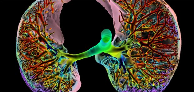 Darstellung einer Lunge: Farbige 3D-Computertomographie (CT) in axialer Ebene bei interstitieller Lungenerkrankung (ILD). 