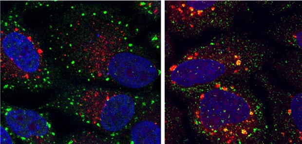 Das Protein und der Stress Farbige Mikroskopie-Aufnahmen, die Zellen mit normalen (grüne Punkte) und abnormalen (gelbe Punkte) Stressgranula zeigen.