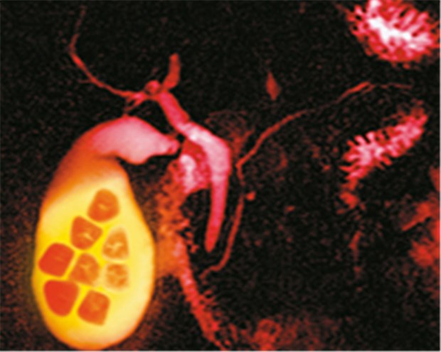 Farbiges MRI von Gallensteinen in der Gallenblase. In westlichen Ländern sind die Gallensteine zu über 90 Prozent cholesterinreich. © Simon Fraser / Science Photo Library