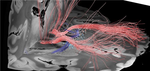 Fasertrakte im Zielgebiet der Hirnstimulation: Dargestellt sind die Elektrodenkontakte bei 50 Patienten mit Zwangsstörungen sowie stimulierte Fasern mit positiven (rot) und negativen (blau) klinischen Ergebnissen.