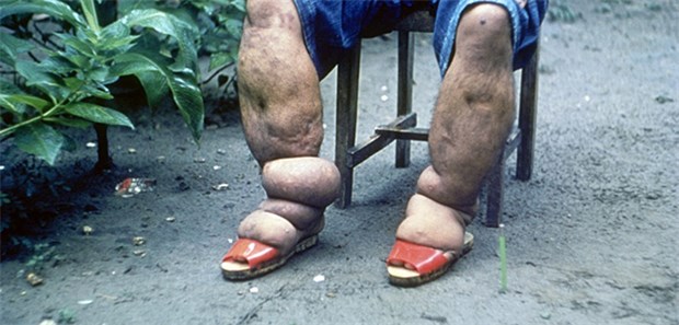 Mehr als Trippelschritte gemacht Fast 560 Millionen Menschen wurden im Jahr 2015 präventiv behandelt, um nicht an Elephantiasis zu erkranken.