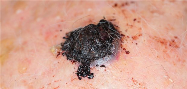 Ein malignes Melanom in Nahansicht. Es ist schwarz und erhebt sich über das Hautniveau.