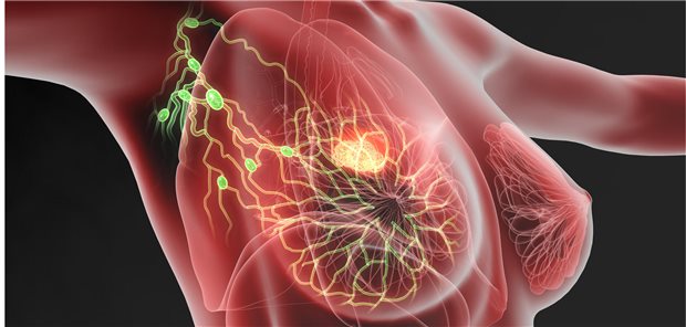 Fazit der Ärztinnen und Ärzte um Dr. Jana de Boniface vom Brustkrebszentrum am Karolinska-Institut in Stockholm ist, dass der Verzicht auf eine vollständige axilläre Lymphknotendissektion bei klinisch nodalnegativen Brusttumoren der Stadien T1–T3 und einem oder zwei Wächterlymphknoten mit Makrometastasen sicher ist, sofern die Betroffenen eine leitliniengerechte Bestrahlung und eine adjuvante systemische Behandlung erhalten.