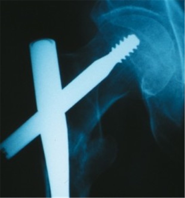 Strontium schützt sehr alte Frauen vor Frakturen Femur eines Patienten im Röntgenbild: Die Fraktur ist mit einem Gamma-Nagel versorgt worden.