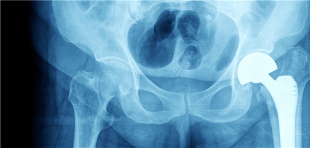 Femurhalsfraktur: Ob HEP oder TEP hatte auf die Zahl der Folgeeingriffe keinen Einfluss. 