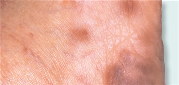 Ferse eines Patienten mit Kaposi-Sarkom. Charakteristisch für den durch Viren ausgelösten Tumor sind die tiefroten Flecken und Knoten auf der Haut.