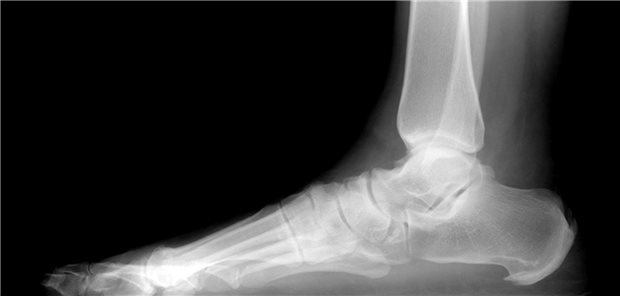 Röntgenbild eines Fußes von lateral mit einem Fersensporn