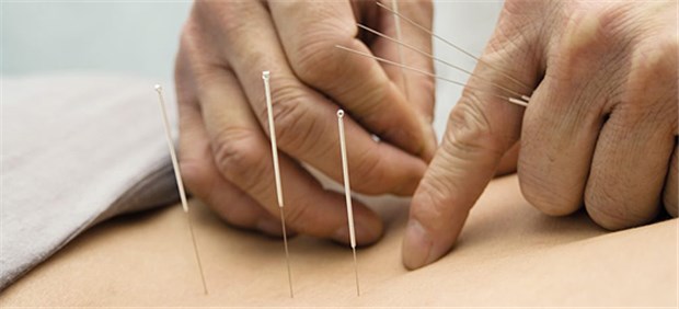 Akupunktur: Wissenschaft oder Scharlatanerie? Fest steht: Akupunktur lindert Schmerzen.