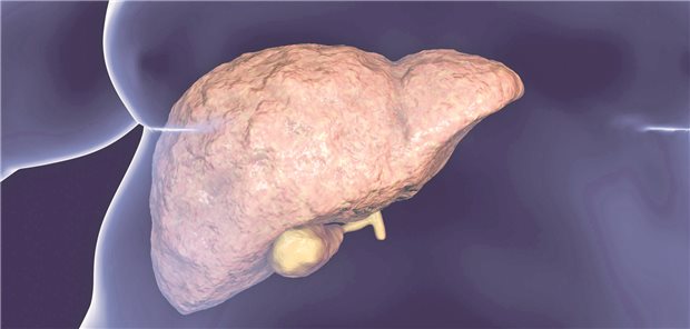 Fettleber – Sobald bei jemandem mit NAFLD eine Fibrose eingetreten ist, geht dies mit einer eingeschränkten Lebenserwartung einher.