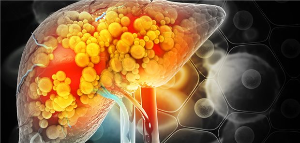 Fettleber im Modell: Die Zahl Betroffener mit assoziierter Zirrhose könnte sich binnen zehn Jahren auf über eine Million verdoppeln, so die DGVS.