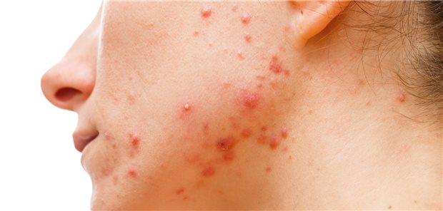 „Fettreduzierte Milch verschlechtert das Hautbild bei Akne stärker als Vollmilch“ – diese Aussage sei nicht ausreichend belegt, betont eine Ernährungsmedizinerin.