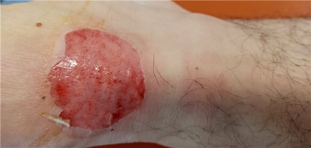 Feuchte Wunden feucht halten! Fotografiert wurde hier eine reizlose große Erosion über dem Sprunggelenk.
