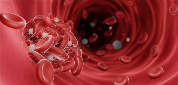 Fibringerinnsel werden ja normalerweise gebildet, um die Blutung während einer Verletzung zu stoppen. Sie können aber auch gefährlich sein, wenn sie den Blutfluss behindern und Thrombosen verursachen.